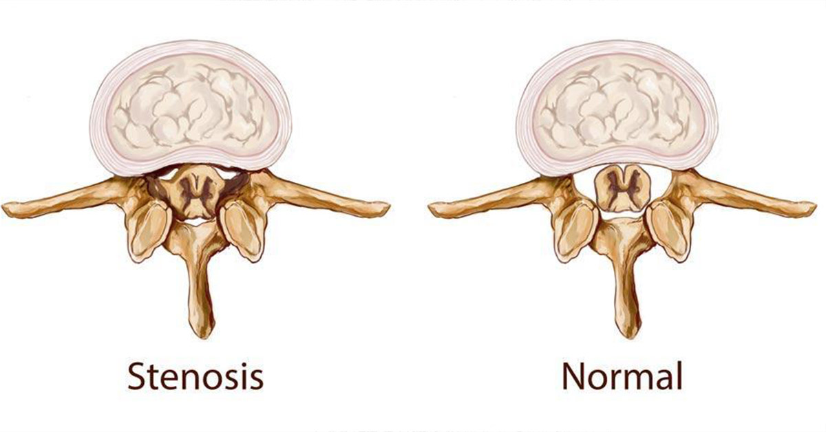 Spinal stenosis