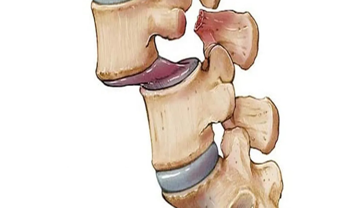 Spondylolisthesis2