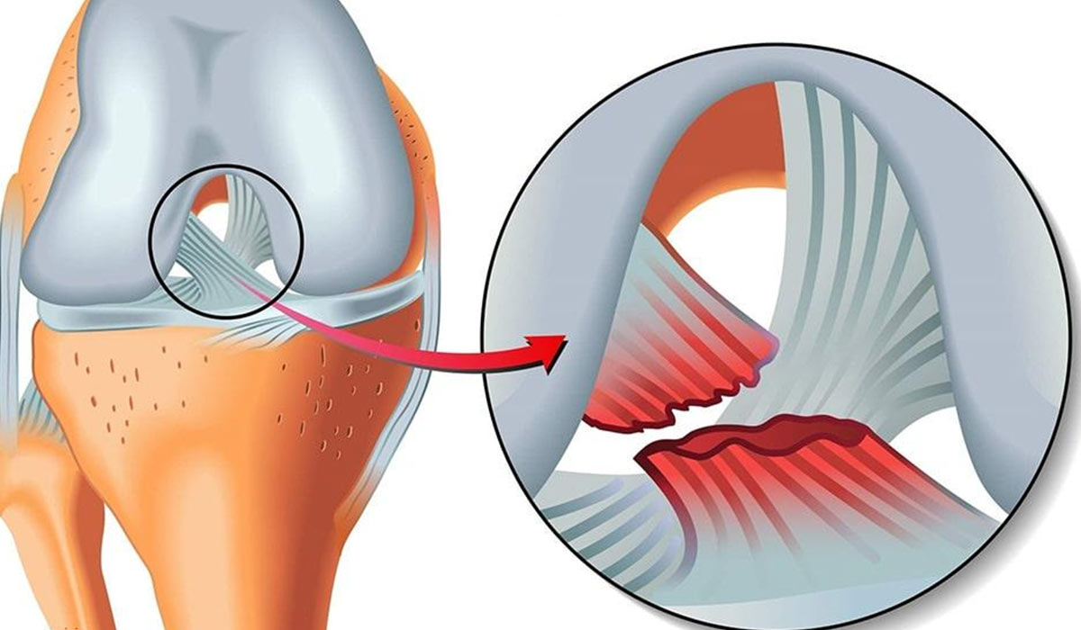 Cruciate ligament treatment3