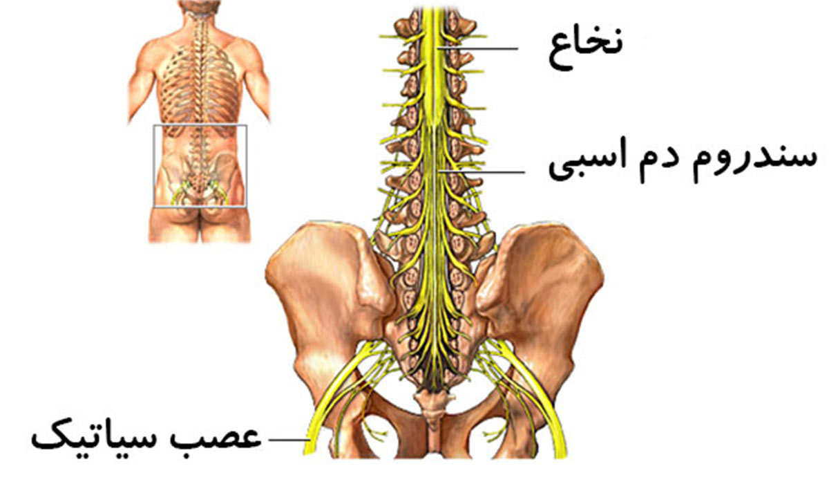 سندروم کودا اکوینا