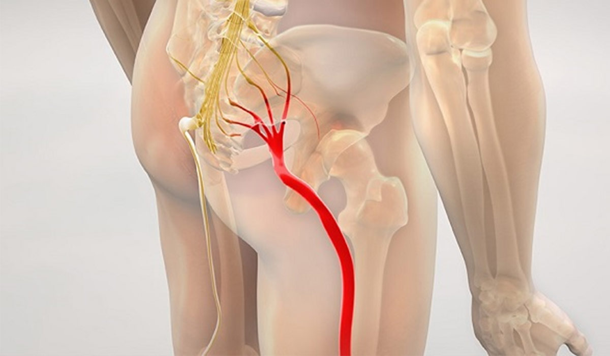 درد زانو بر اثر سیاتیک