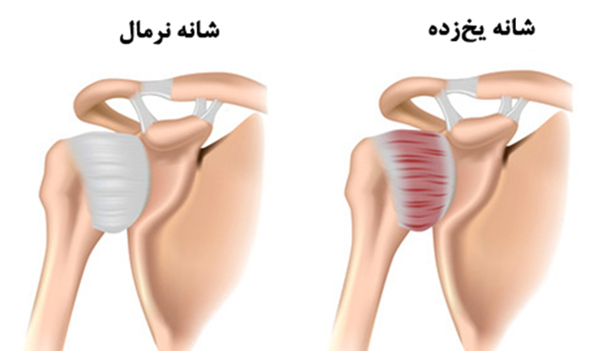 کپسولیت چسبنده