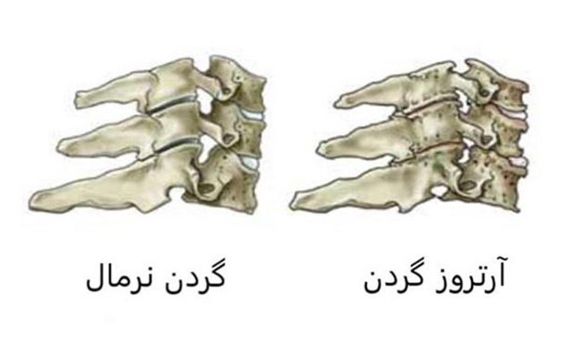 درمان آرتروز گردن