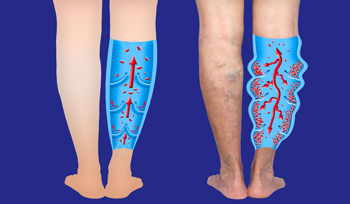 Varicose veins