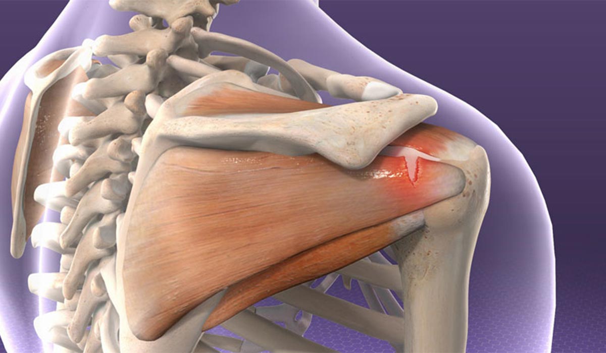 علت تاندونیت شانه