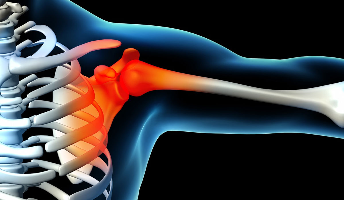 shoulder tendonitis